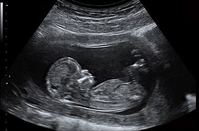 Echographie, un examen indolore et sans danger pendant la grossesse
